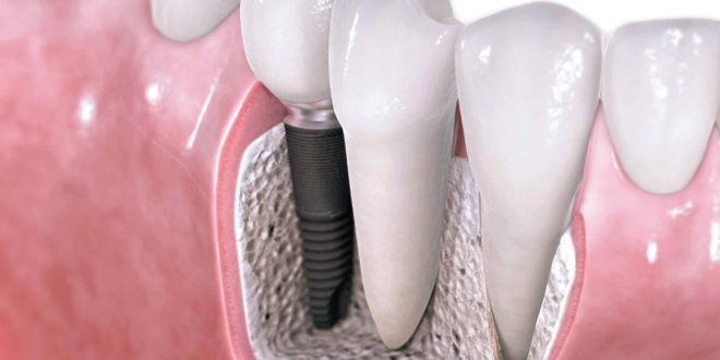 Что нужно знать про имплантацию зубов