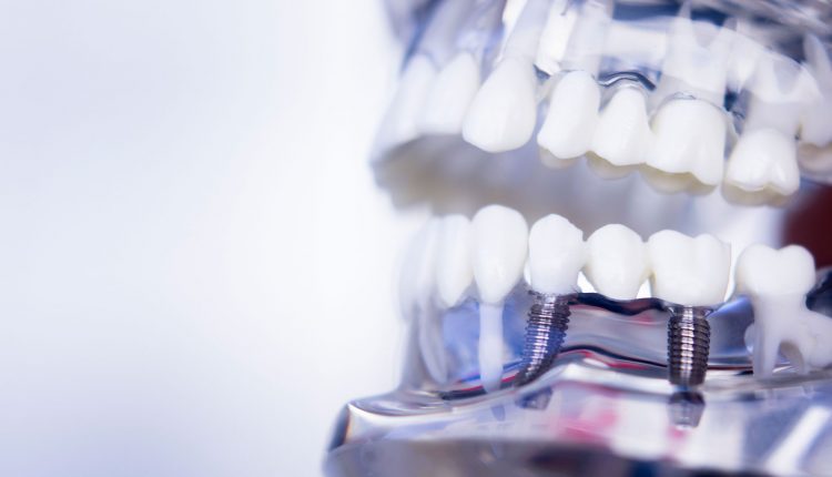 Почему не стоит верить мифам о зубных имплантатах
